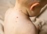 Jersey to follow UK recommendation on chickenpox vaccine for children