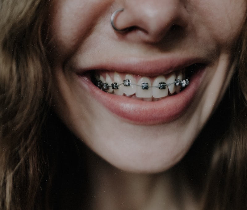 girl_teeth_braces.jpg