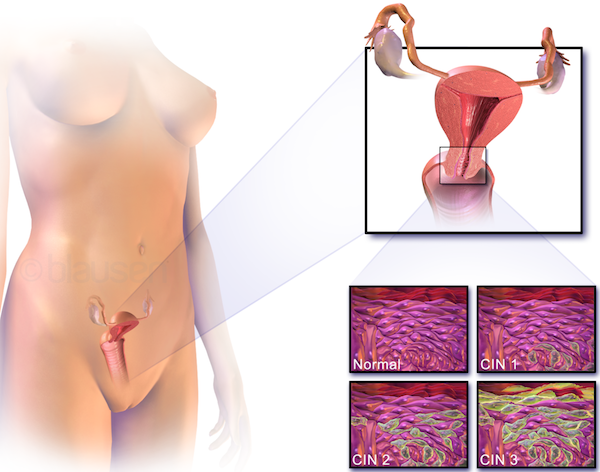 cervical cancer hpv
