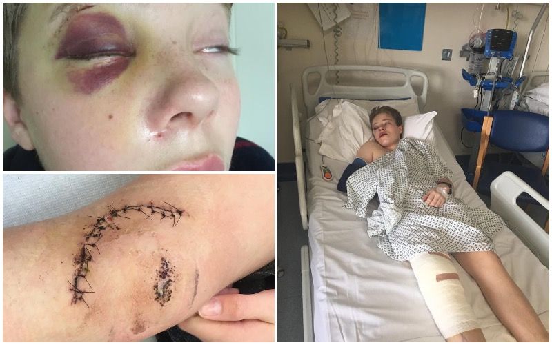 Plea for law change after 14-year-old’s serious bike crash