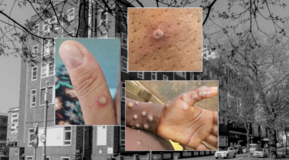 “Highly probable” Monkeypox case identified in Jersey