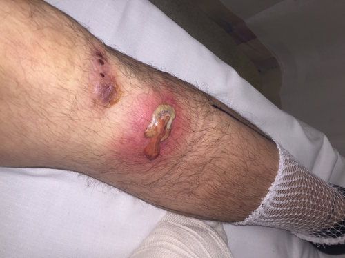 Footballer needed hospital treatment after injury from artificial pitch