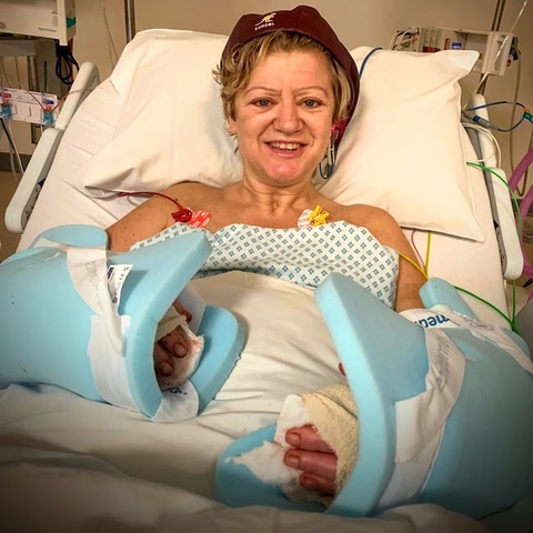 Connie_Hutton_hand_transplant.jpeg