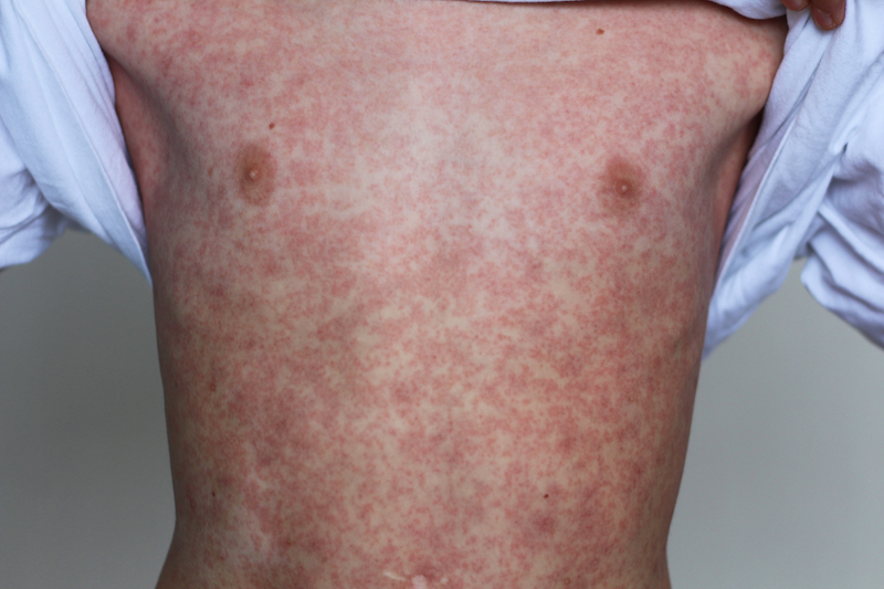 shutterstock measles