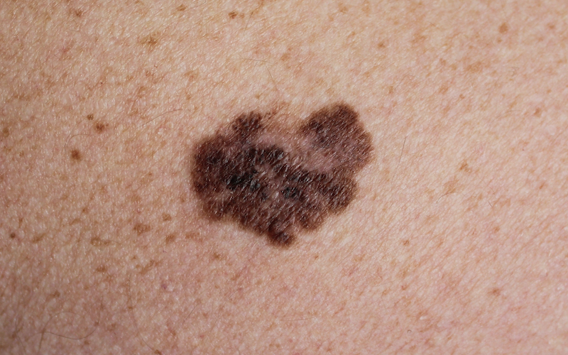 Melanoma.jpg