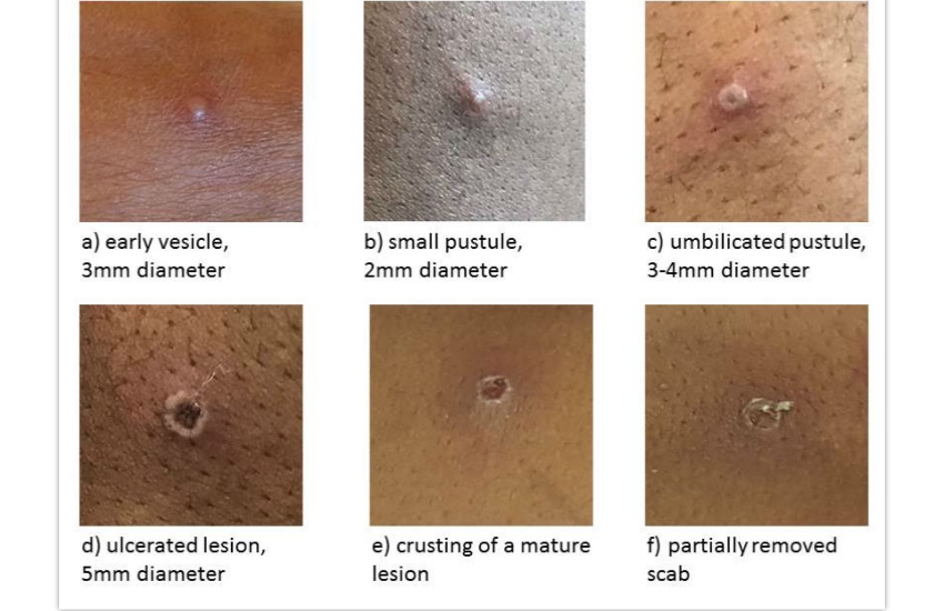 Monkeypox_scabs_Credit_gov.uk.jpg
