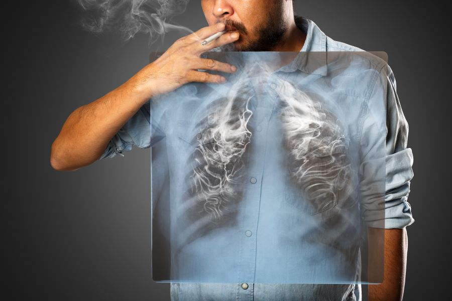 smoking_xray.jpg
