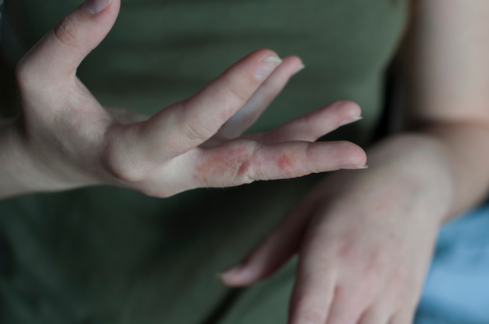 scabies_stock.jpg